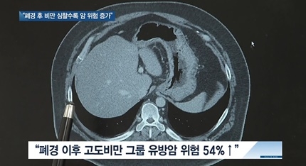 [쿠키건강뉴스] “폐경 후 비만 심할수록 암 발생 위험 증가”