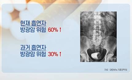 [쿠키건강뉴스] 흡연자 방광암 위험 60% 높아…“혈뇨 보이면 원인 검사”