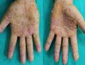 “수족 잘리는 듯한 고통” 산정특례 지정에서 소외된 ‘손발바닥 농포증’ 환자